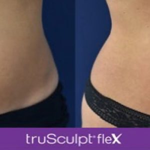 Get the Chance to Achieve those Toned Abs with TruSculpt Flex