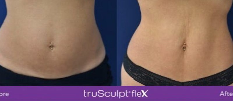 Get the Chance to Achieve those Toned Abs with TruSculpt Flex